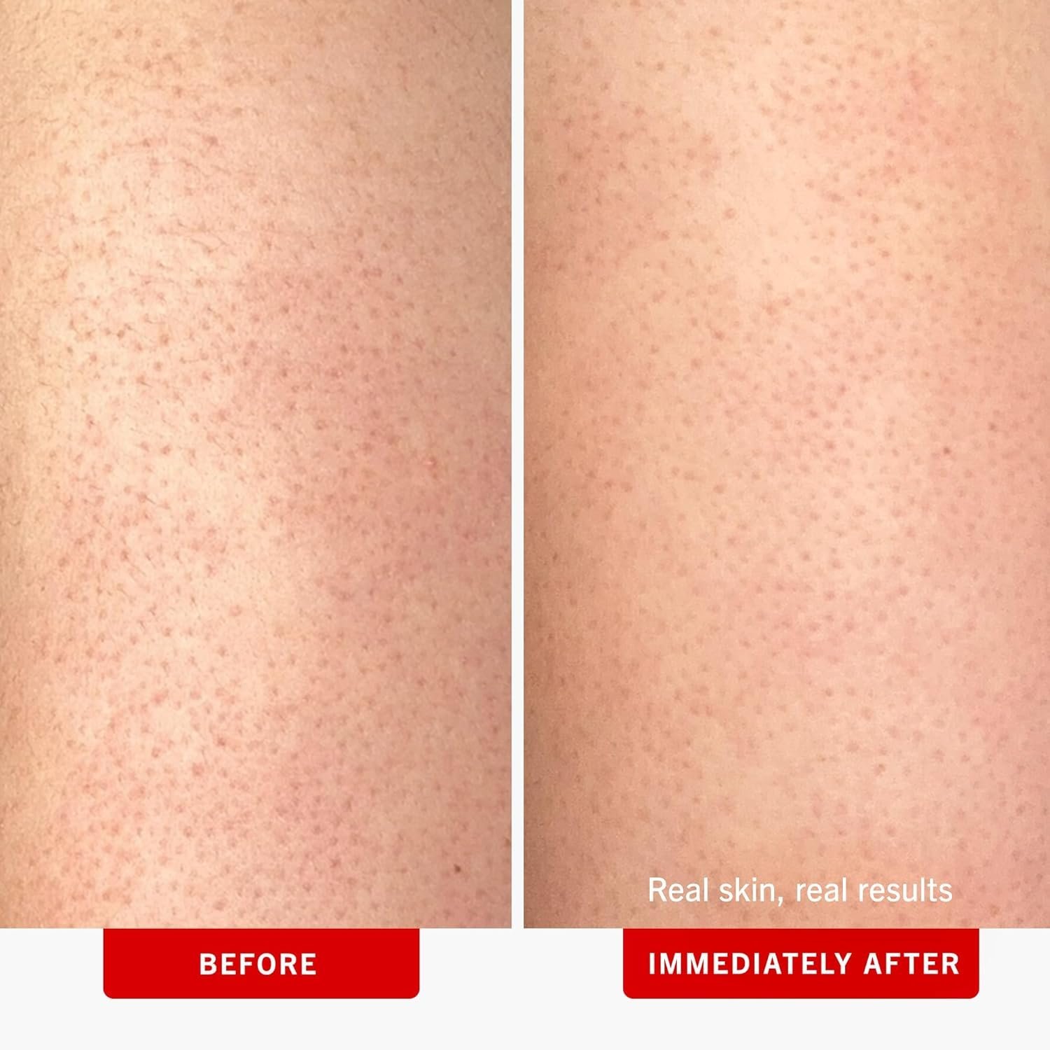 First Aid Beauty - KP Bump Eraser Body Scrub with 10% AHA, Keratosis Pilaris Skin Exfoliater with Glycolic and Lactic acids, Helps Reduce Chicken Skin Bumps, Safe for Sensitive Skin, 10 oz - Image 2